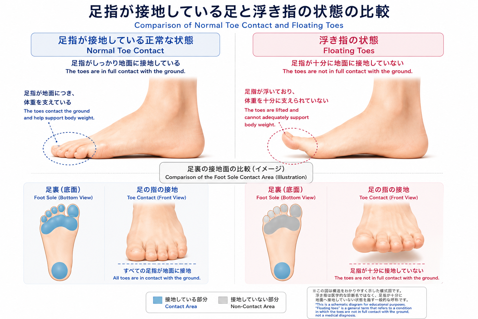 浮き指とは